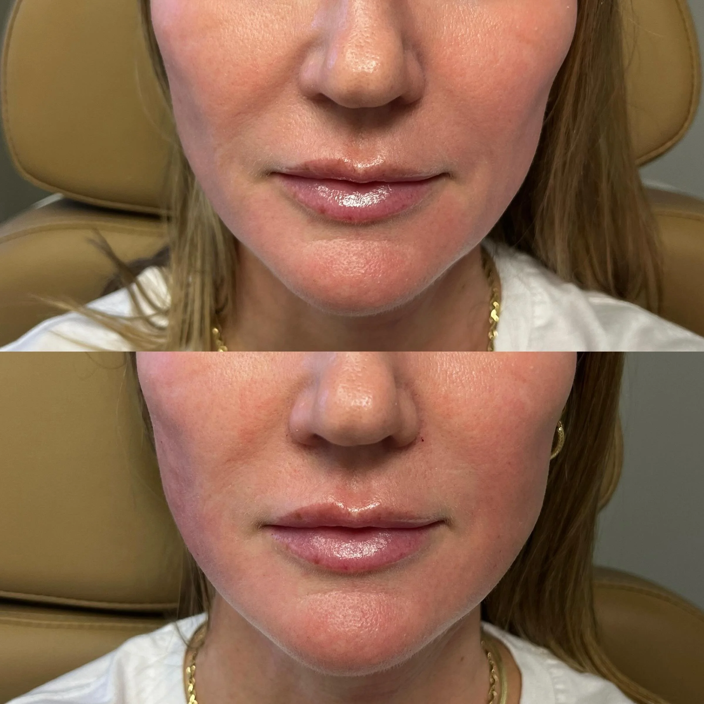 Already flawless, just maintaining the magic ✨

She&rsquo;s done an amazing job keeping up with her biostimulation and tox, creating beautiful skin quality and structure over time. Her lips (by me 💓) were already perfectly settled, soft, and natural