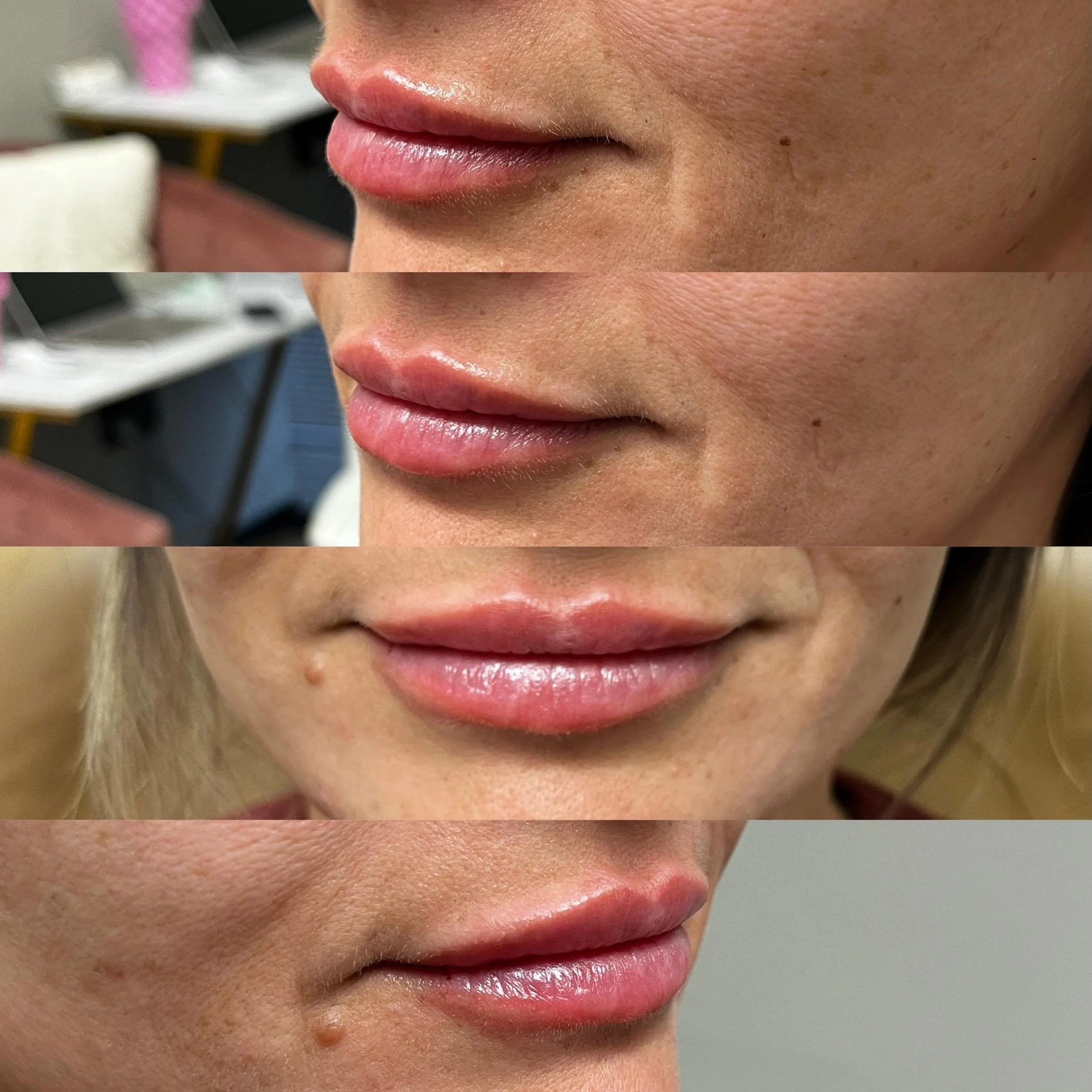 ✨ Meet Evolysse Smooth ✨

The newest generation of hyaluronic acid filler has arrived, and it&rsquo;s changing the filler game. 💉

Evolysse Smooth is designed using innovative Cold-X&trade; technology, which helps preserve the natural structure of h