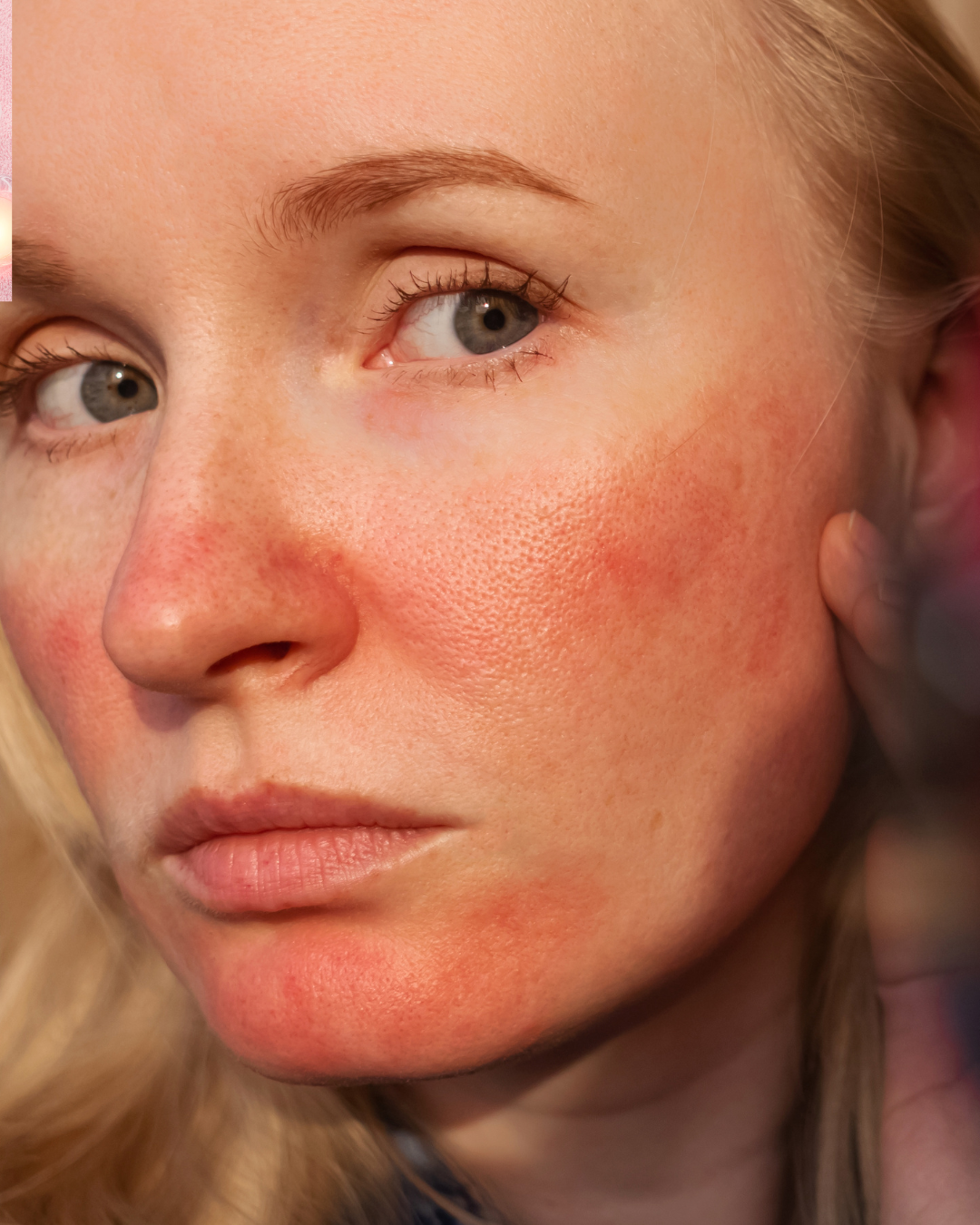 Rosacea: What It Is + How to Calm It Naturally