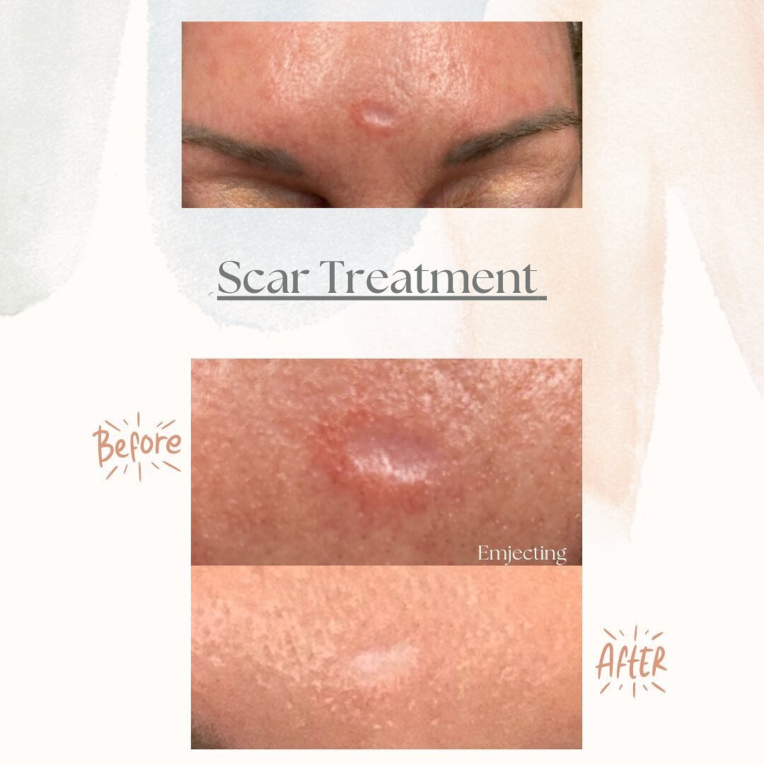 This client had treatment at another business and unfortunately, was burned by a laser targeting an area of pigmentation right in the middle of her forehead.
Burns are a risk of laser treatment and in this case, likely a result of overly aggressive s