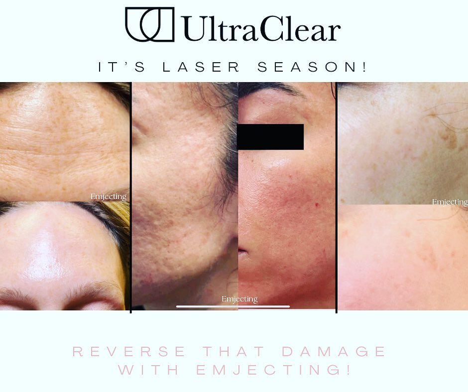 We love our @ultraclearlaser using Erbium technology to offer benefits on the superficial and deep level to improve skin tone, texture, laxity and pigment. We are now entering the perfect time of year in Florida to start your laser journey!