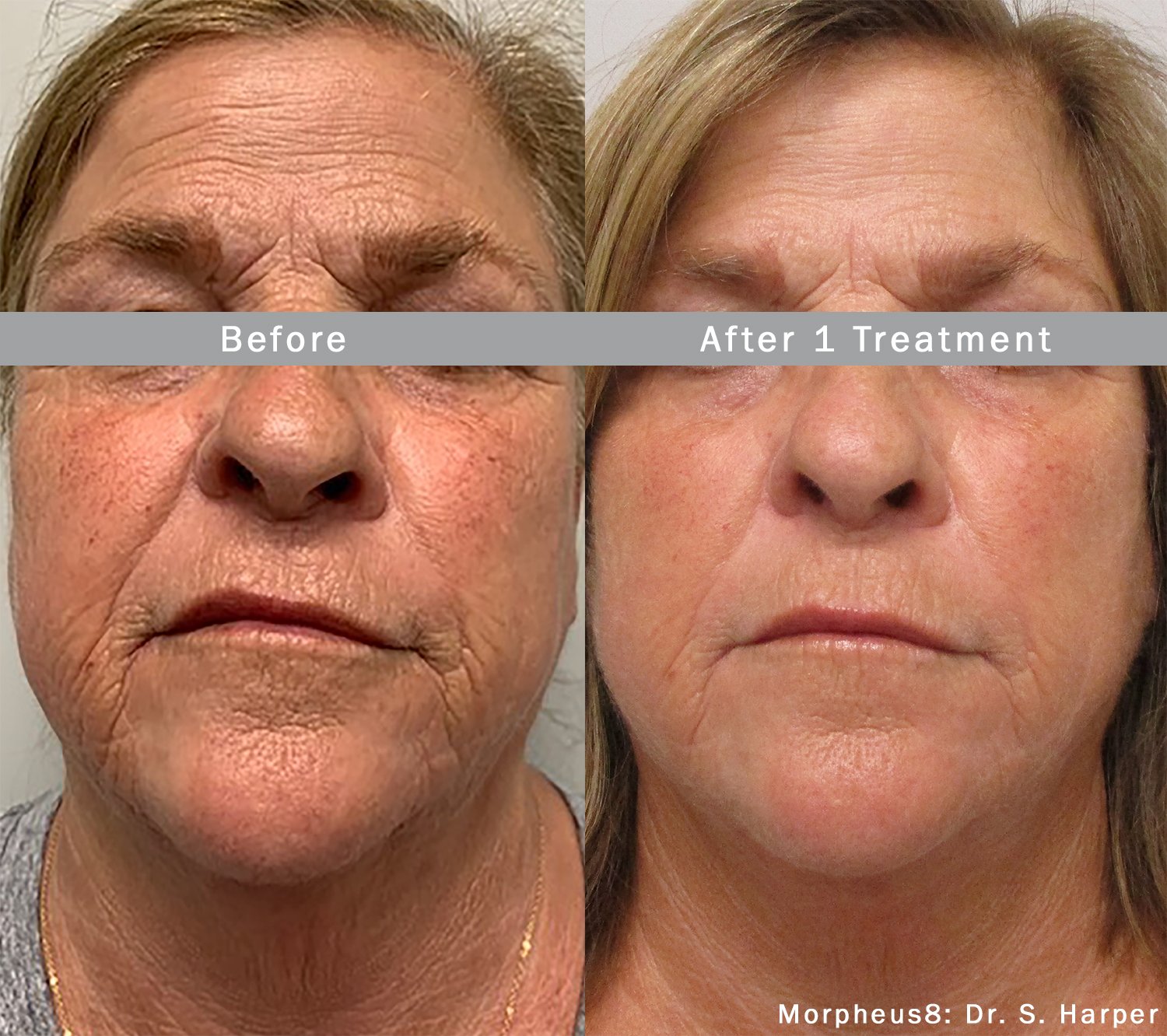 morpheus8-before-after-dr-s-harper-preview-2.jpeg