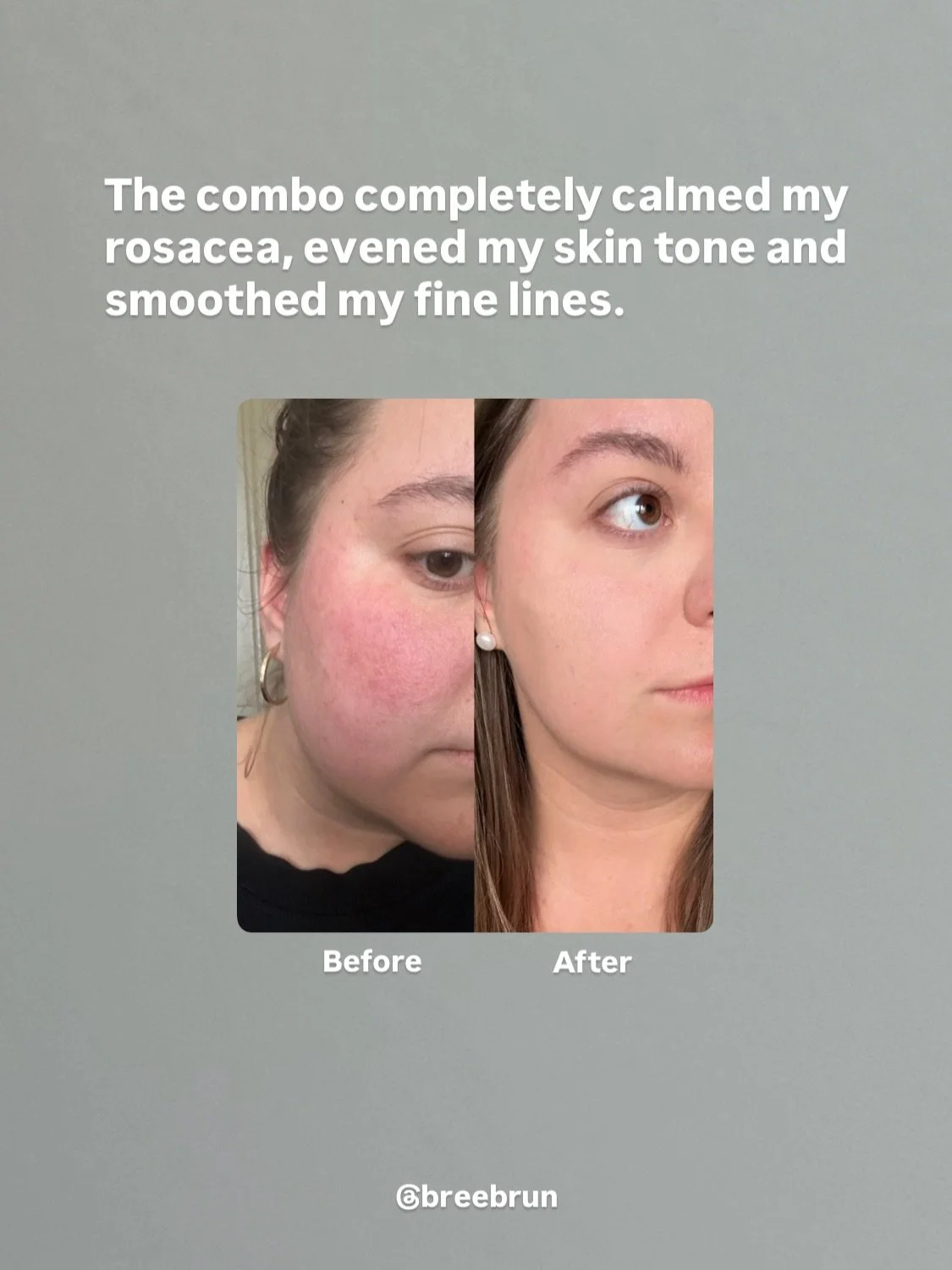 Before and after comparison photo showing reduced facial redness and more even skin tone after combining green tea with red light therapy