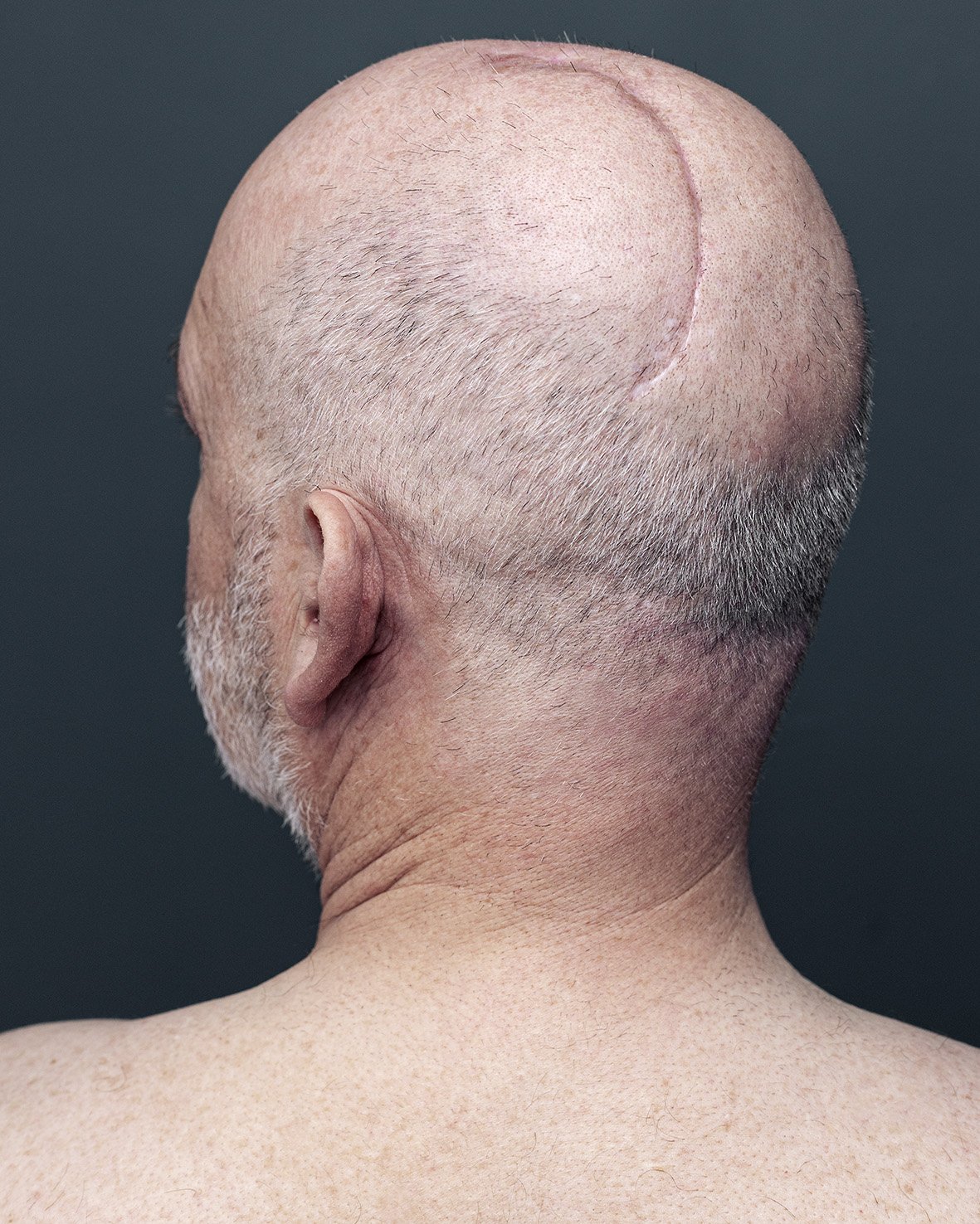 Thierry. Oedème au cerveau