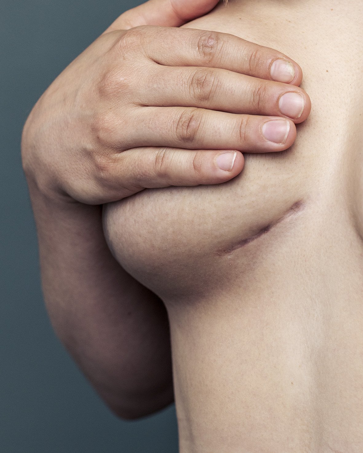 Atteinte d'un cancer du sein. Elle est aujourd'hui en rémission.