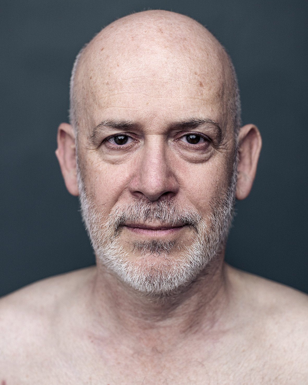 Thierry. Oedème au cerveau