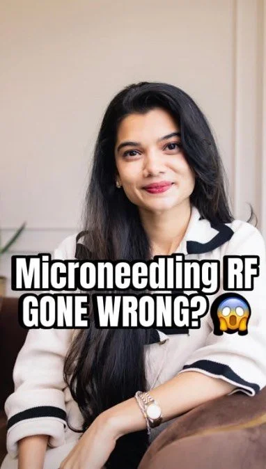 Microneedling RF is all the hype now! But make sure you do it with an experienced doctor so you don’t end up worse than you started off!
.
.
.
.
.
[ Microneedling, trending, trending skin treatments , skin tightening , youthful skin #skintextu