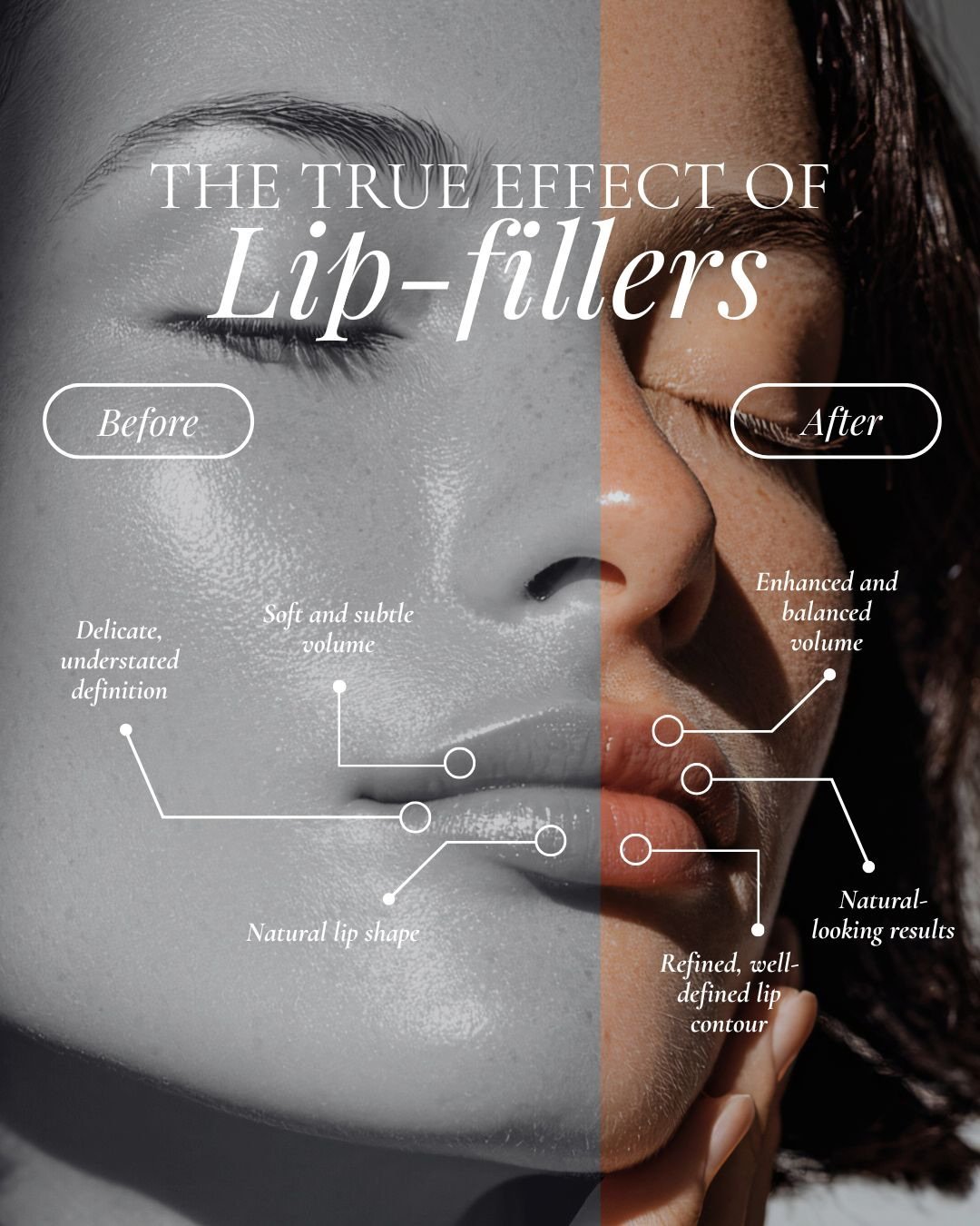 DM US KNOW TO KNOW MORE ABOUT LIP FILLERS🙌
.
(lip fillers,lips,fillers,pout,skin,aesthetics)
.
#lipfillers #fillers #botox #plumplips #lips