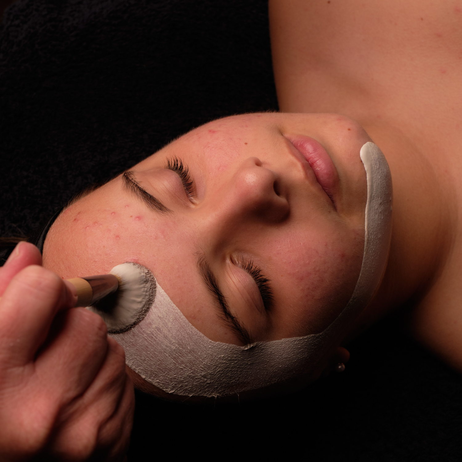 corneotherapy acne treatment Paddington Brisbane