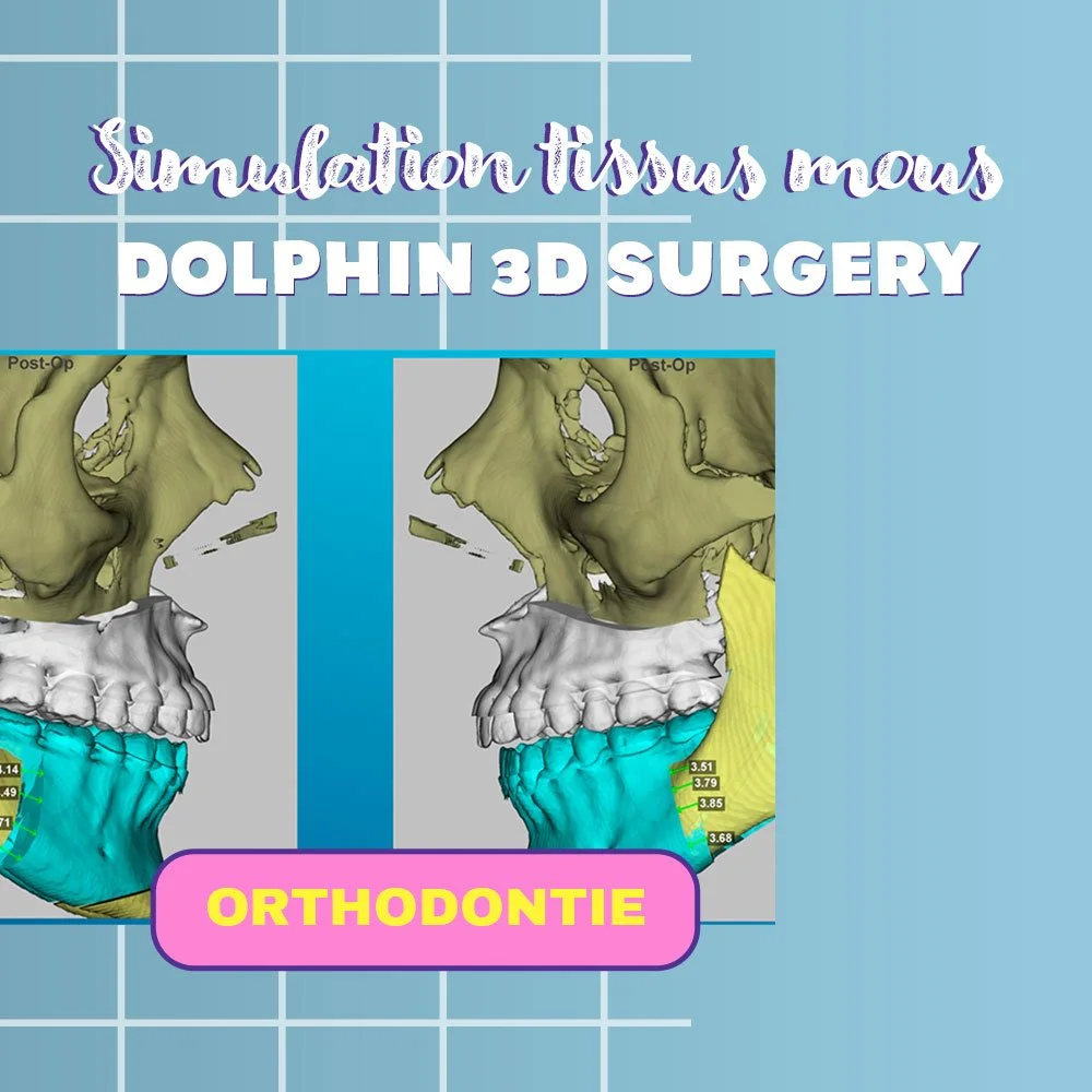 Simulation des tissus mous en chirurgie orthognathique avec Dolphin 3D Surgery : entre prédiction et réalité