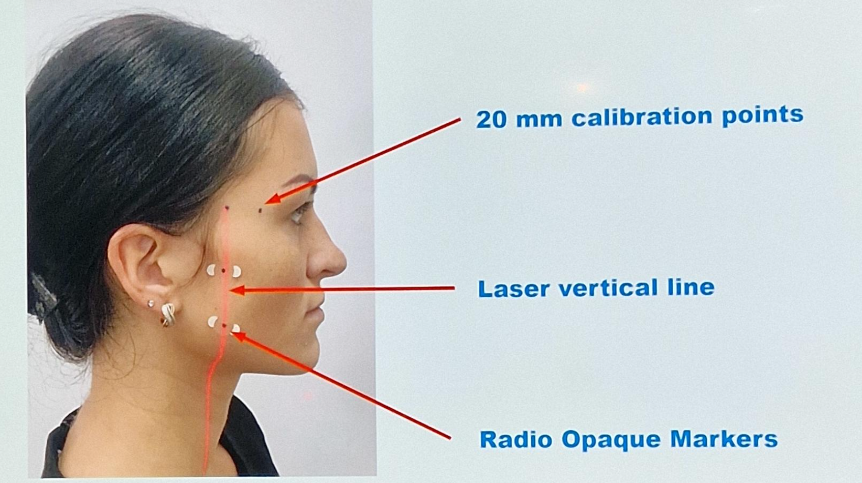 Graphique : Définition des plans de référence (plan frontal, plan médian, plan occlusal), calibration horizontale et verticale, et correction des rotations Cant/Yaw/Roll/Pitch — slide 7