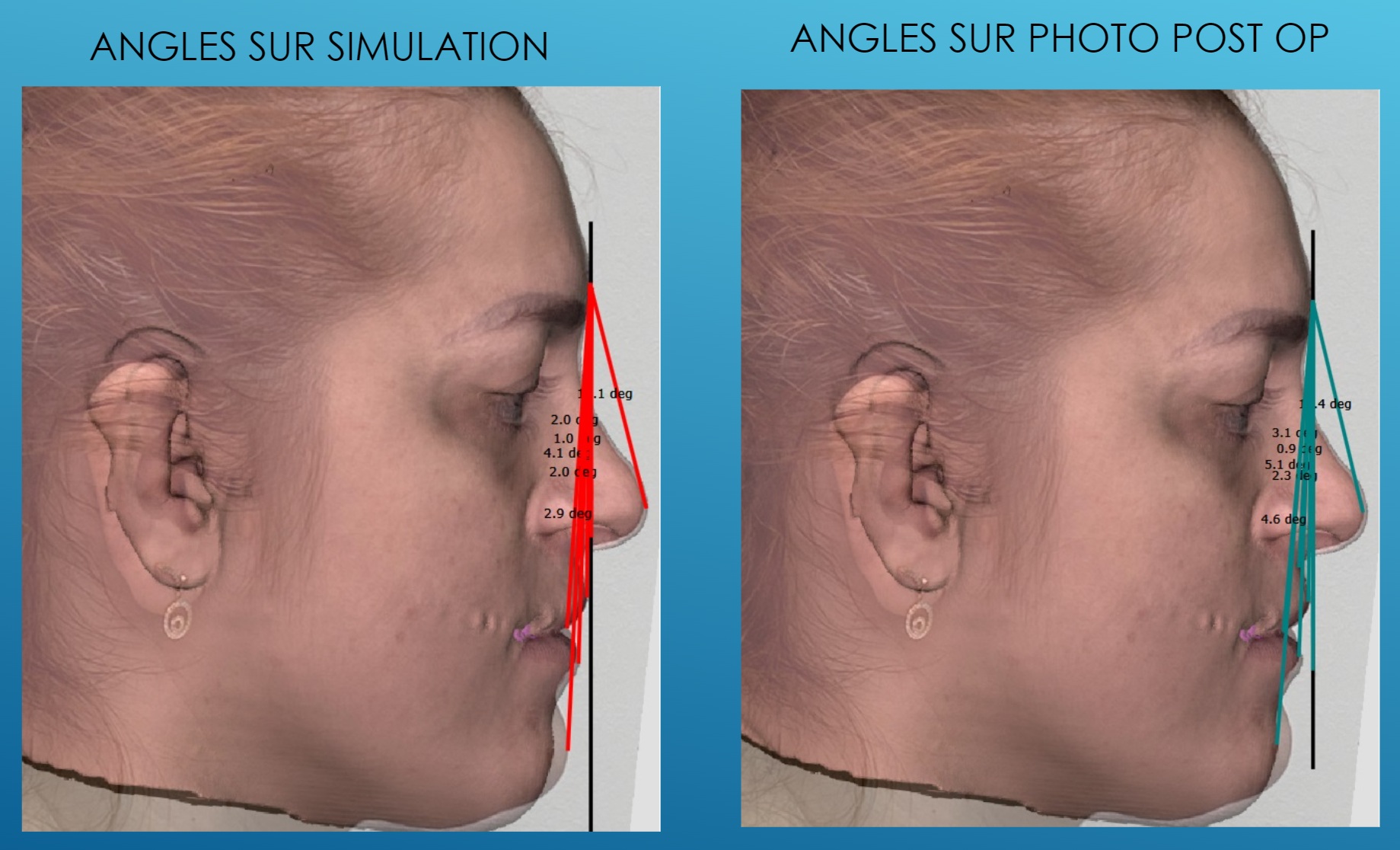 Graphique : Étude quantitative — méthode : comparaison de l’angle (verticale glabelle / point anatomique) entre simulation et photo post-op — slide 24