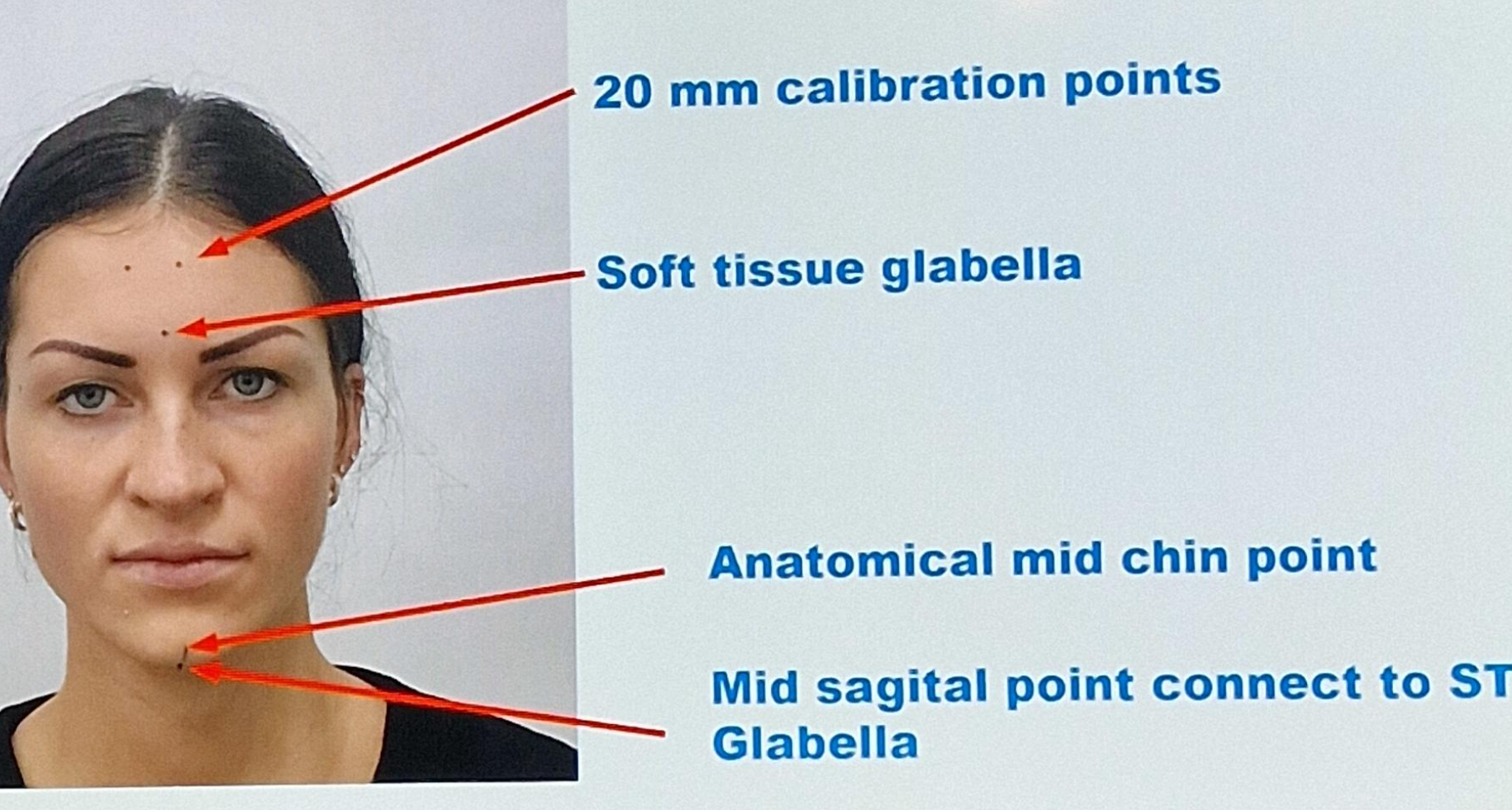 Graphique : Vérification du plan sagittal médian — procédure glabelle/menton théorique/menton anatomique et mesure de distance — slide 6