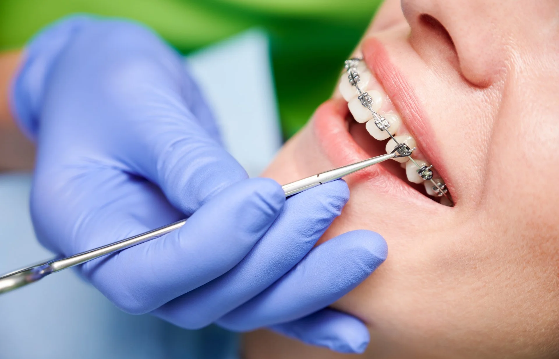 Traitement orthodontique par bagues chez un patient adulte