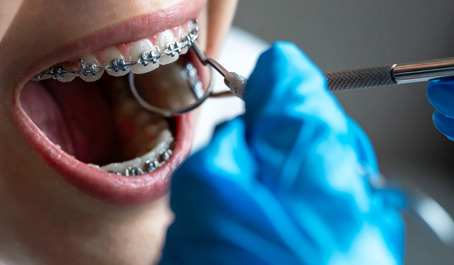 Traitement par bagues avec contrôle de l'orthodontiste