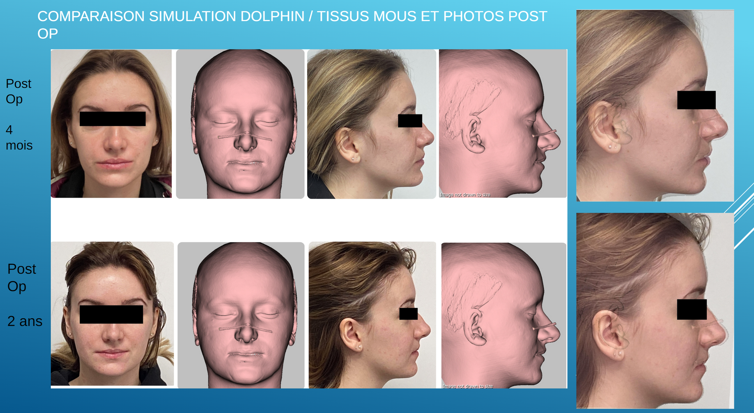Graphique : Comparaison post-opératoire — 4 mois vs 2 ans — slide 14