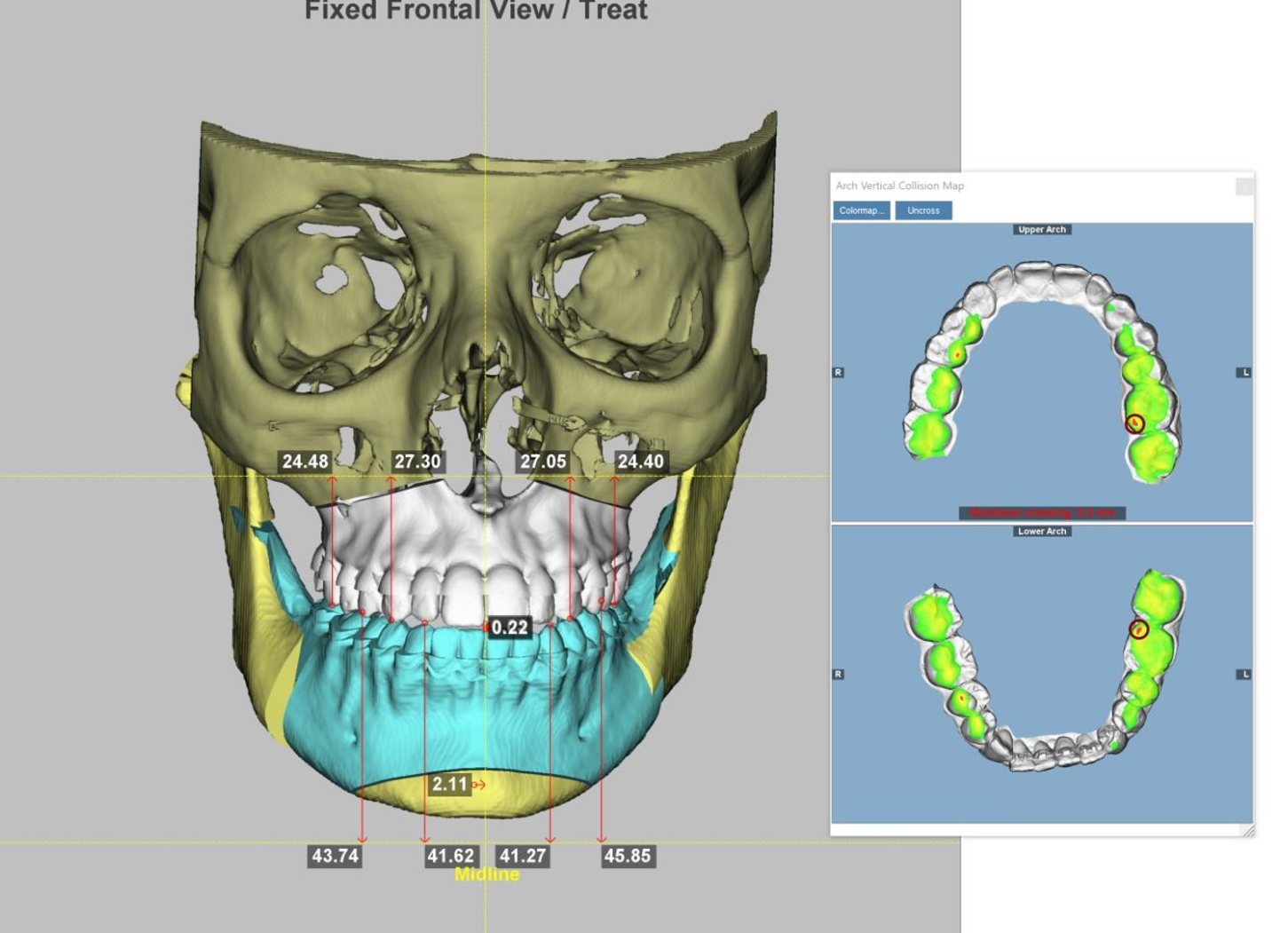 Graphique : Cas HR — visualisation des contacts occlusaux en fonction des mouvements chirurgicaux simulés — slide 11