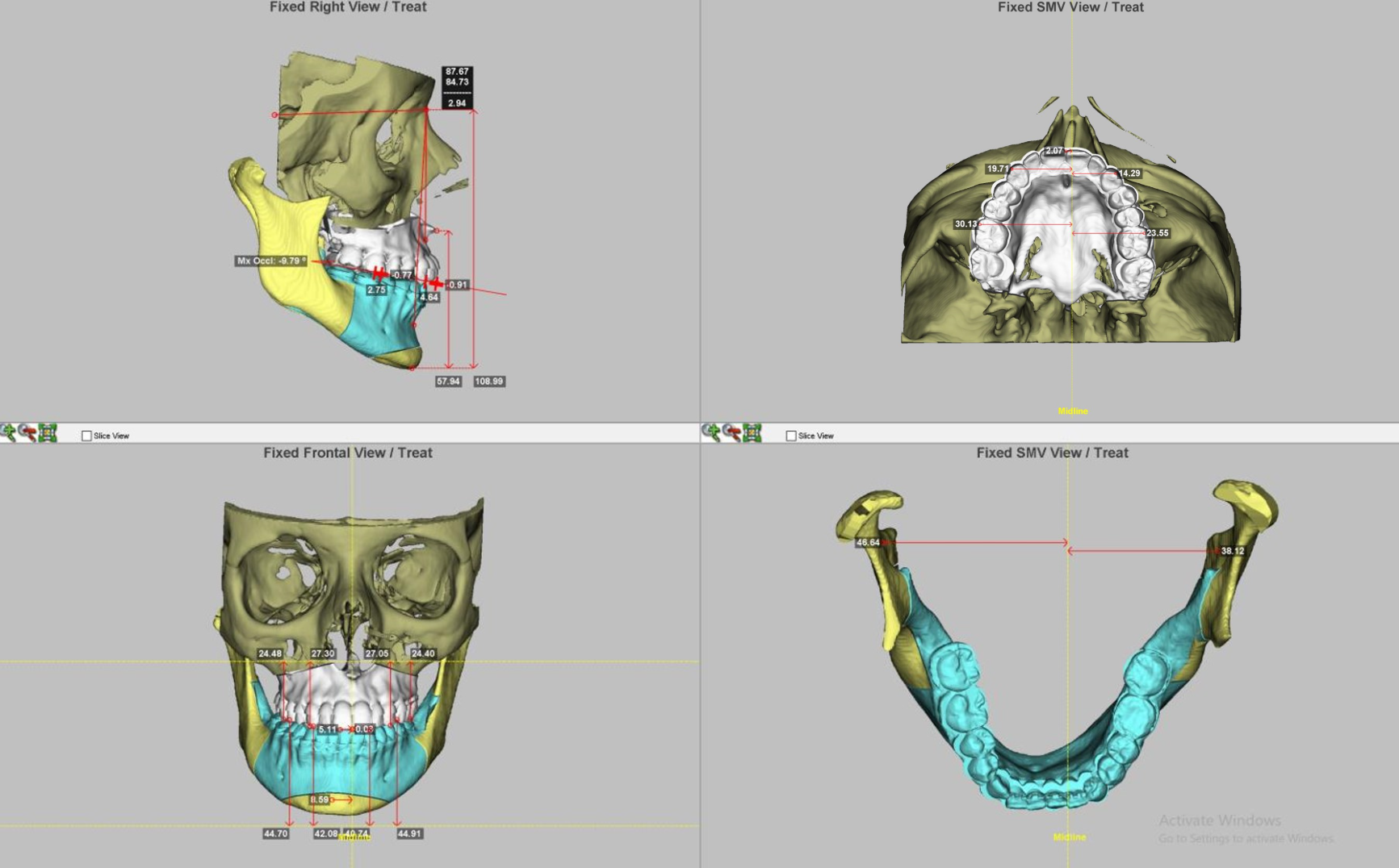 Graphique : Cas HR — préparation chirurgicale (mesures déviation maxillaire/mandibulaire, quantification mouvements) — slide 10