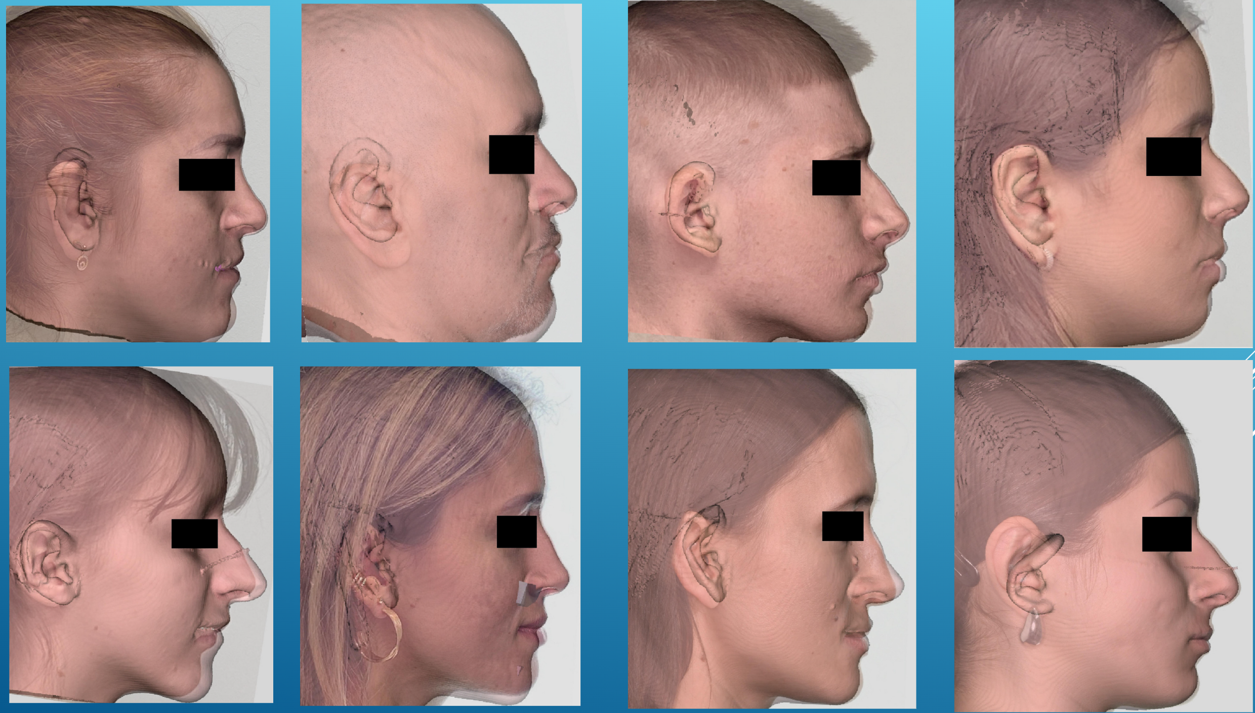 Graphique : Superpositions photo post-op / simulation Dolphin — slide 23