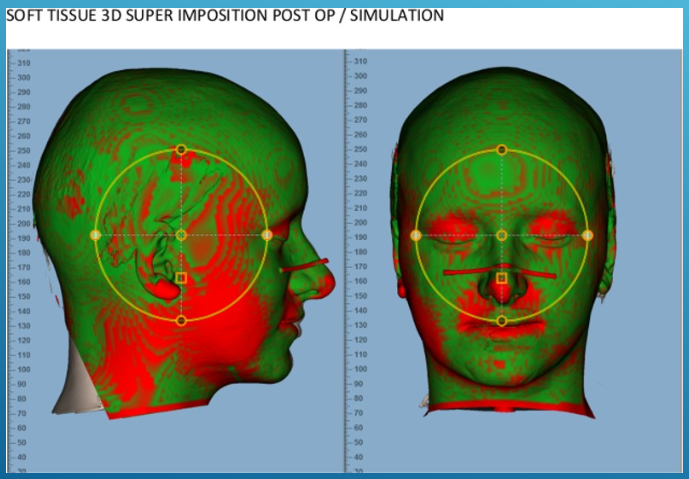Graphique : Analyse des résultats — principes d’évaluation et superposition des tissus mous : simulation et post-op — slide 13