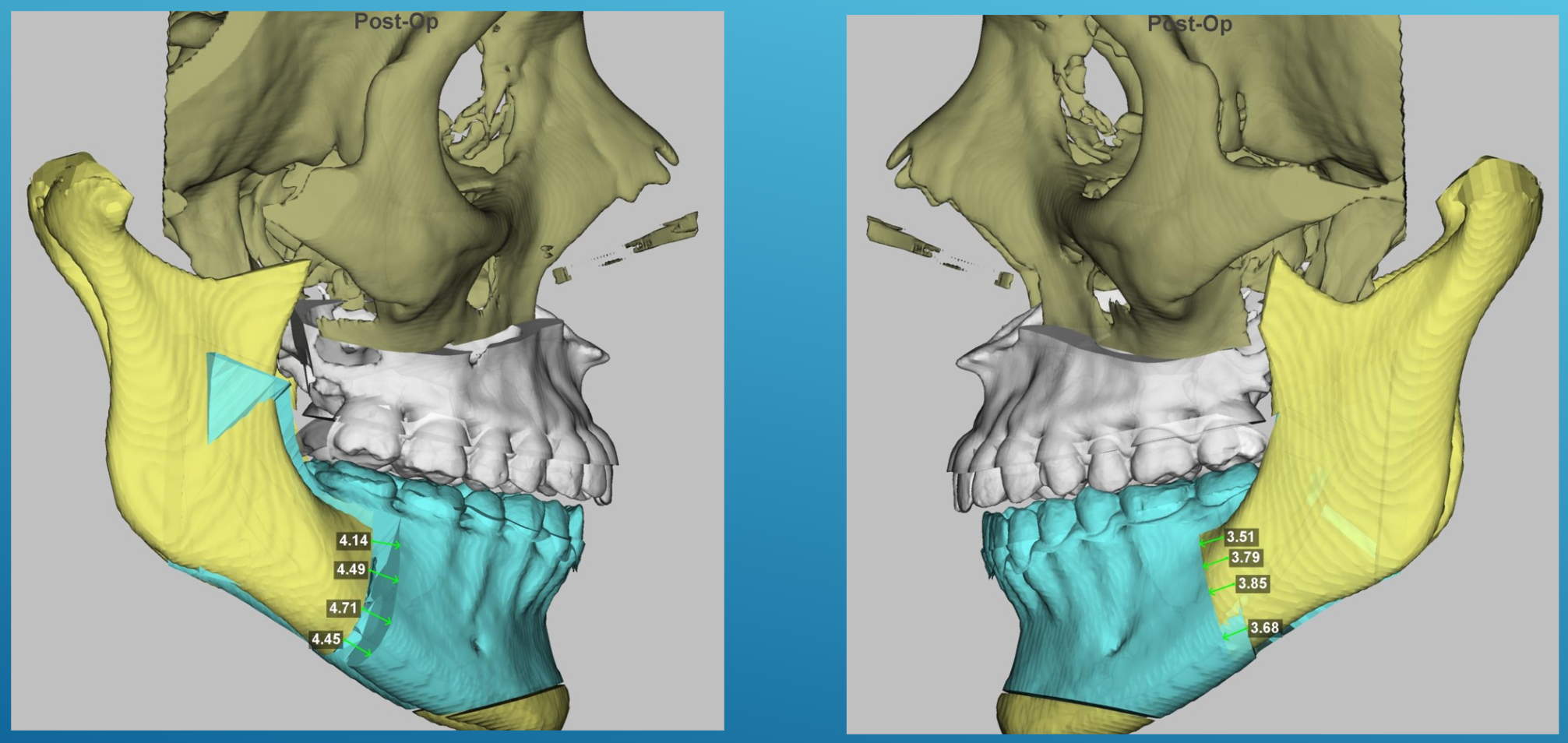 Graphique : Visualisation des interférences osseuses entre segments distaux et proximaux (conflits de valves) — slide 8