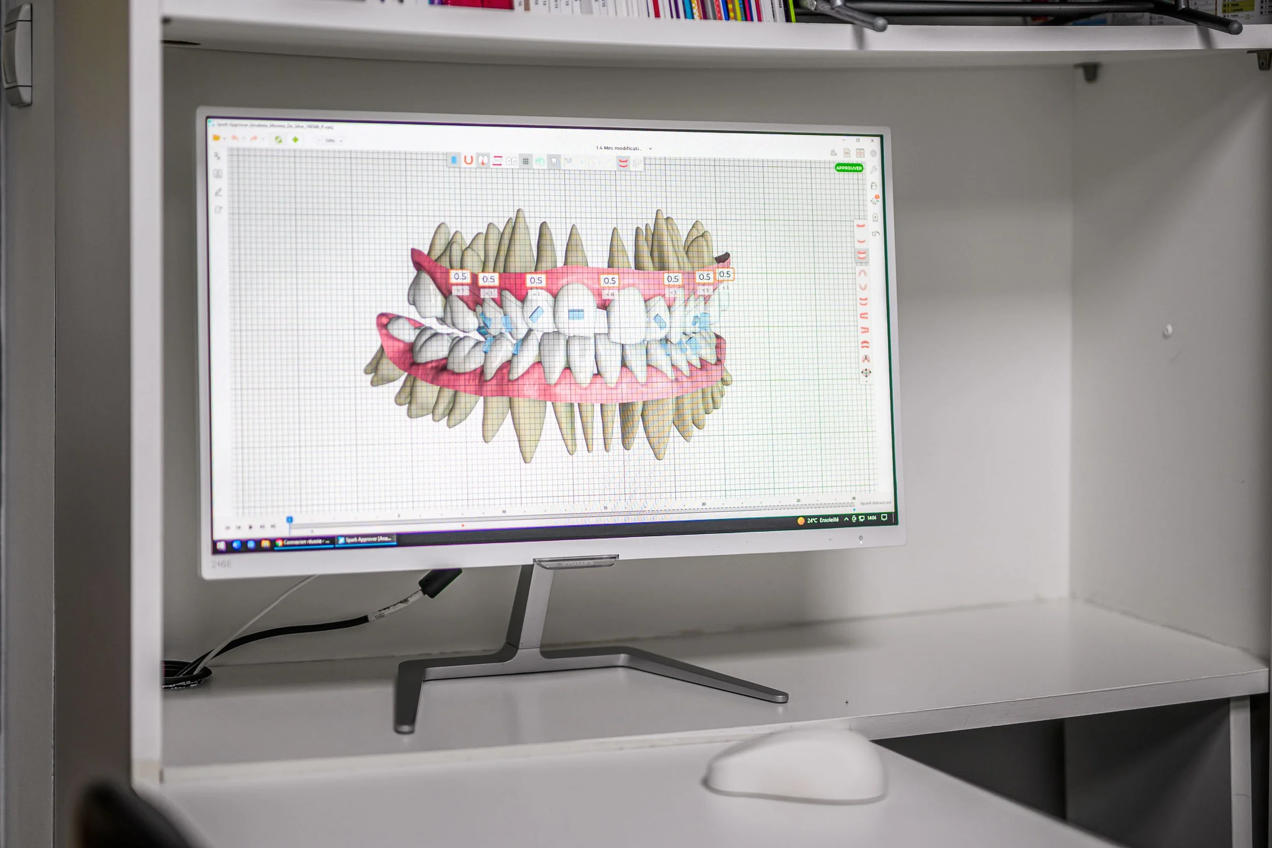 Simulation de traitement orthodontique avec aligneurs invisibles par orthodontiste