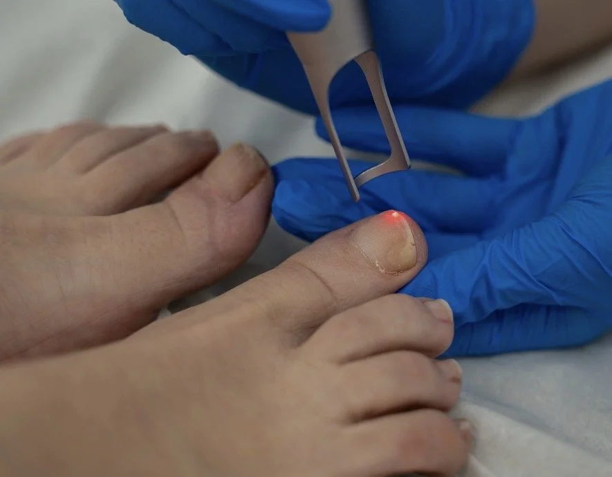 FUNGAL TOENAIL TREATMENT QUEENSTOWN LASER FOR FUNGAL NAILS