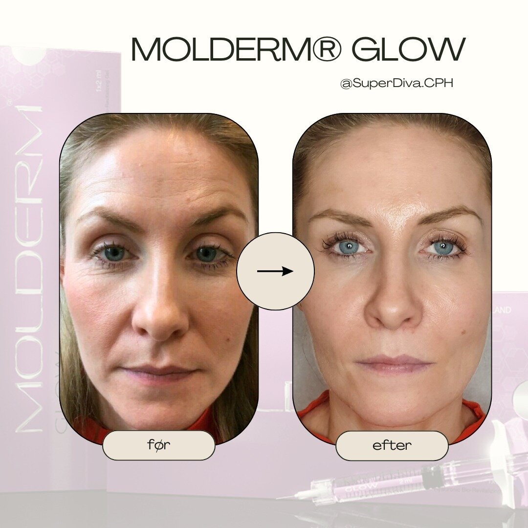 🌟 Oplev Varig Sk&oslash;nhed med MOLDERM&reg; GLOW &ndash; Holder op til et helt &aring;r! 🌟

Vi introducerer med stolthed MOLDERM&reg; GLOW fra Molderm Aesthetics' revolutionerende anti-aging program. Dette unikke, ikke-krydsbundne gelprodukt er d