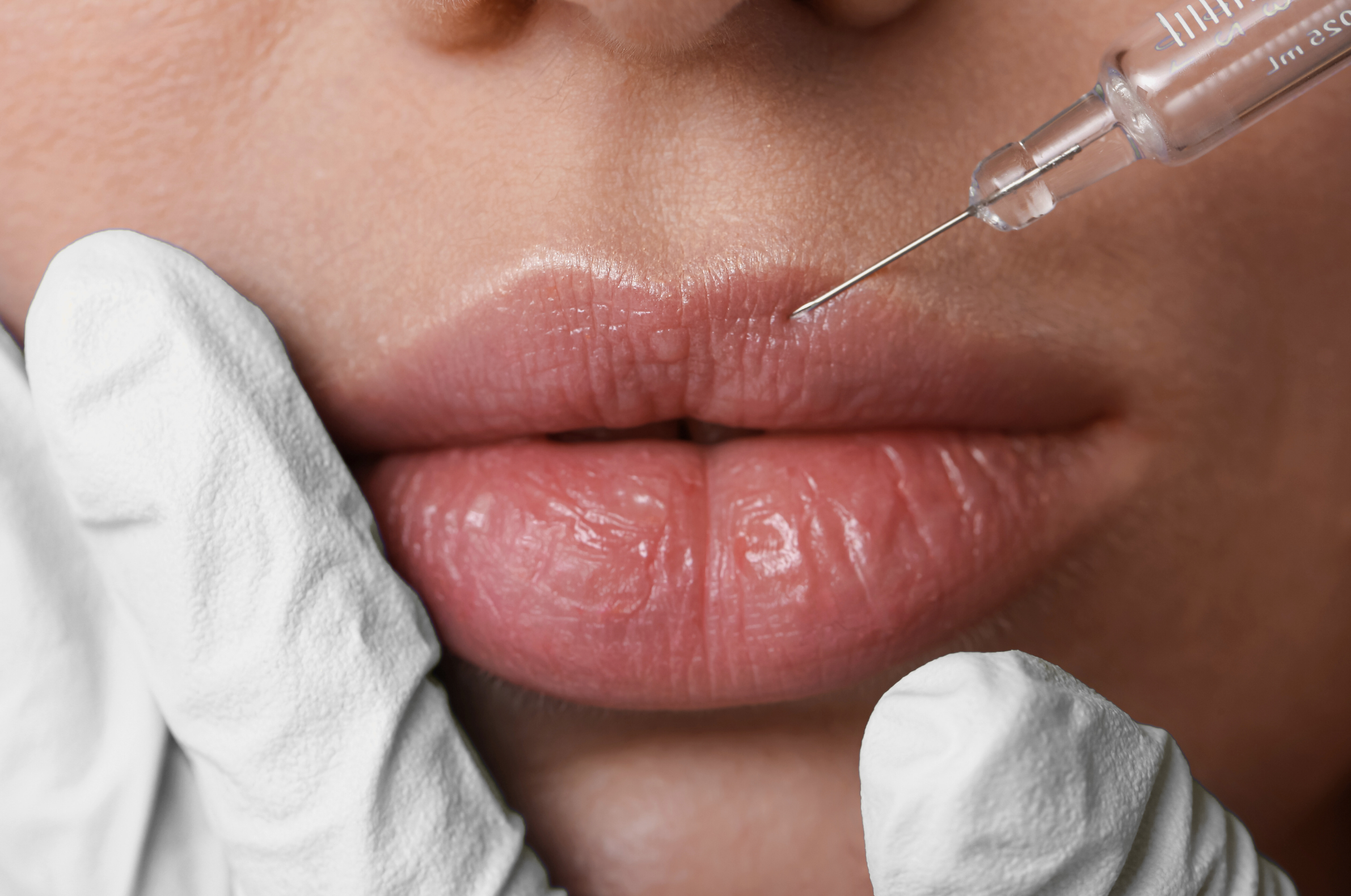 CHAPTER FORTY-EIGHT: Everything You Need to Know About Our Revanesse® Lip Filler