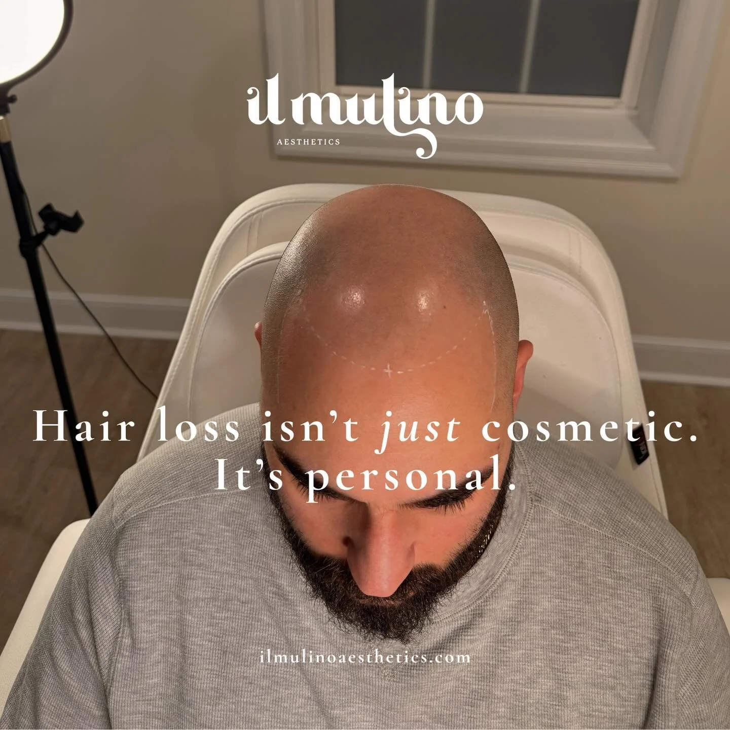 We&rsquo;re expanding the Il Mulino Aesthetics experience with Scalp Micropigmentation &mdash; a non-surgical solution for hair loss and thinning designed to deliver immediate, natural-looking results.

This is SMP done with intention, precision, and