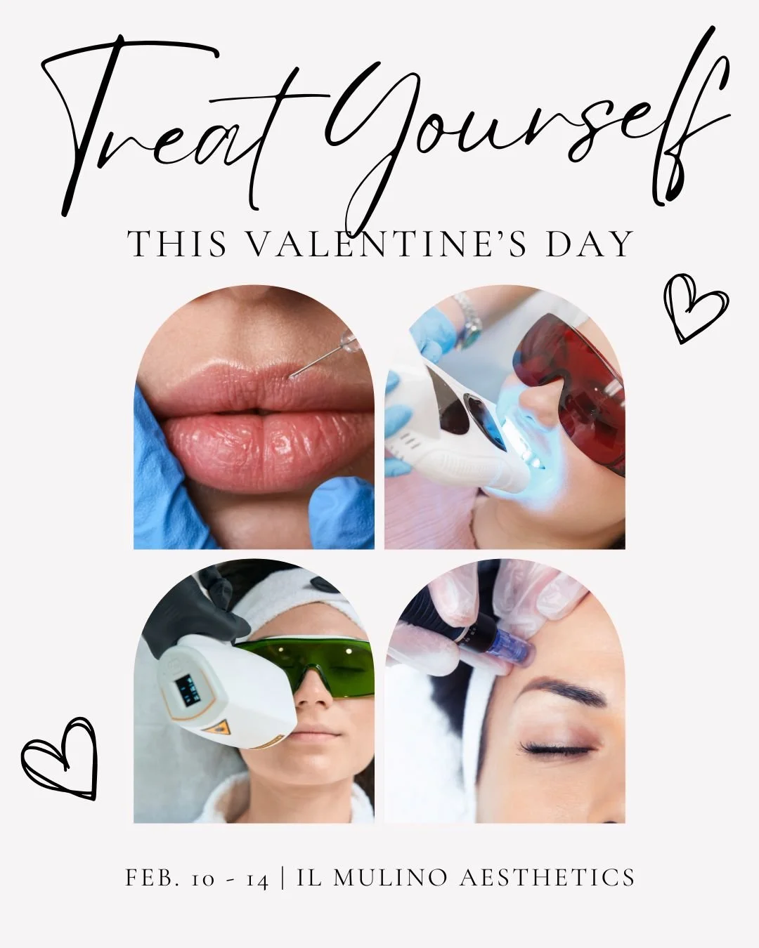 The perfect love story: You and an uninterrupted appointment at Il Mulino Aesthetics! 

Here are our limited Valentine&rsquo;s Week promos from Feb 10&ndash;14:

💋Lip Filler &ndash; $629/syringe (normally $725&ndash;$750)
😁Complimentary 30-minute t