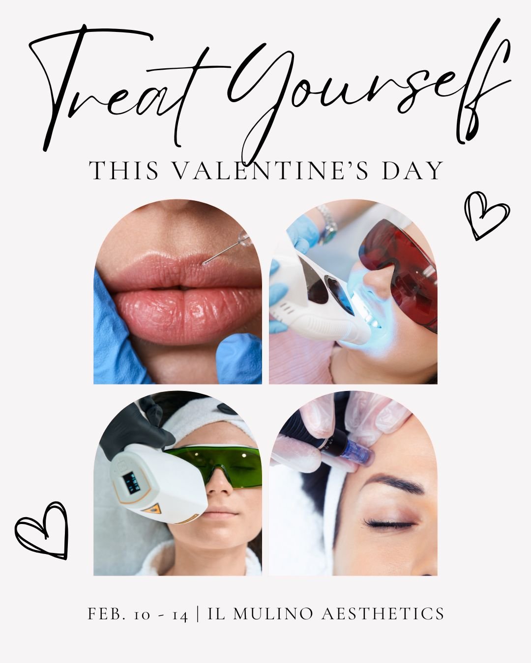 The perfect love story: You and an uninterrupted appointment at Il Mulino Aesthetics! 

Here are our limited Valentine&rsquo;s Week promos from Feb 10&ndash;14:

💋Lip Filler &ndash; $629/syringe (normally $725&ndash;$750)
😁Complimentary 30-minute t