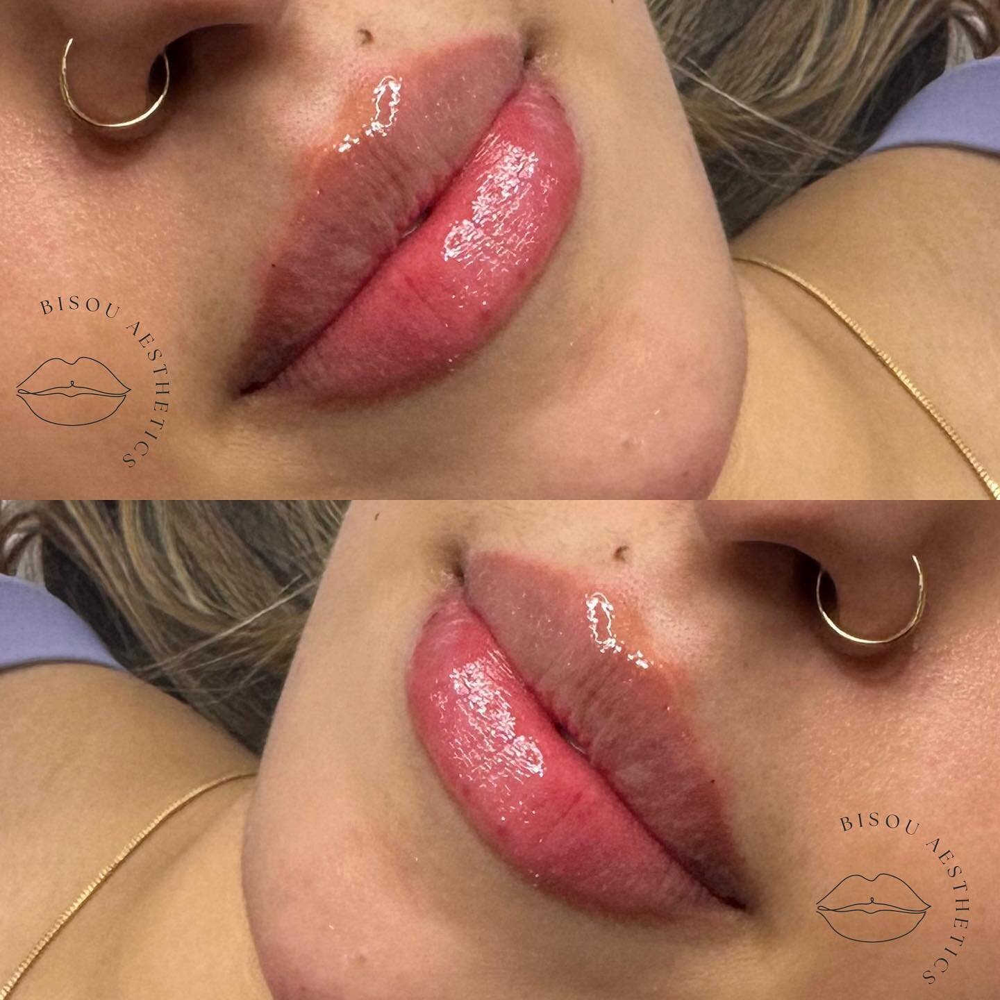 Showstopper Lips👄💫

Exclusive Lip Filler promo is on till July 31st✨ Book Now!

#lipfiller #torontolipfiller #lipcheck #lipenhancement
