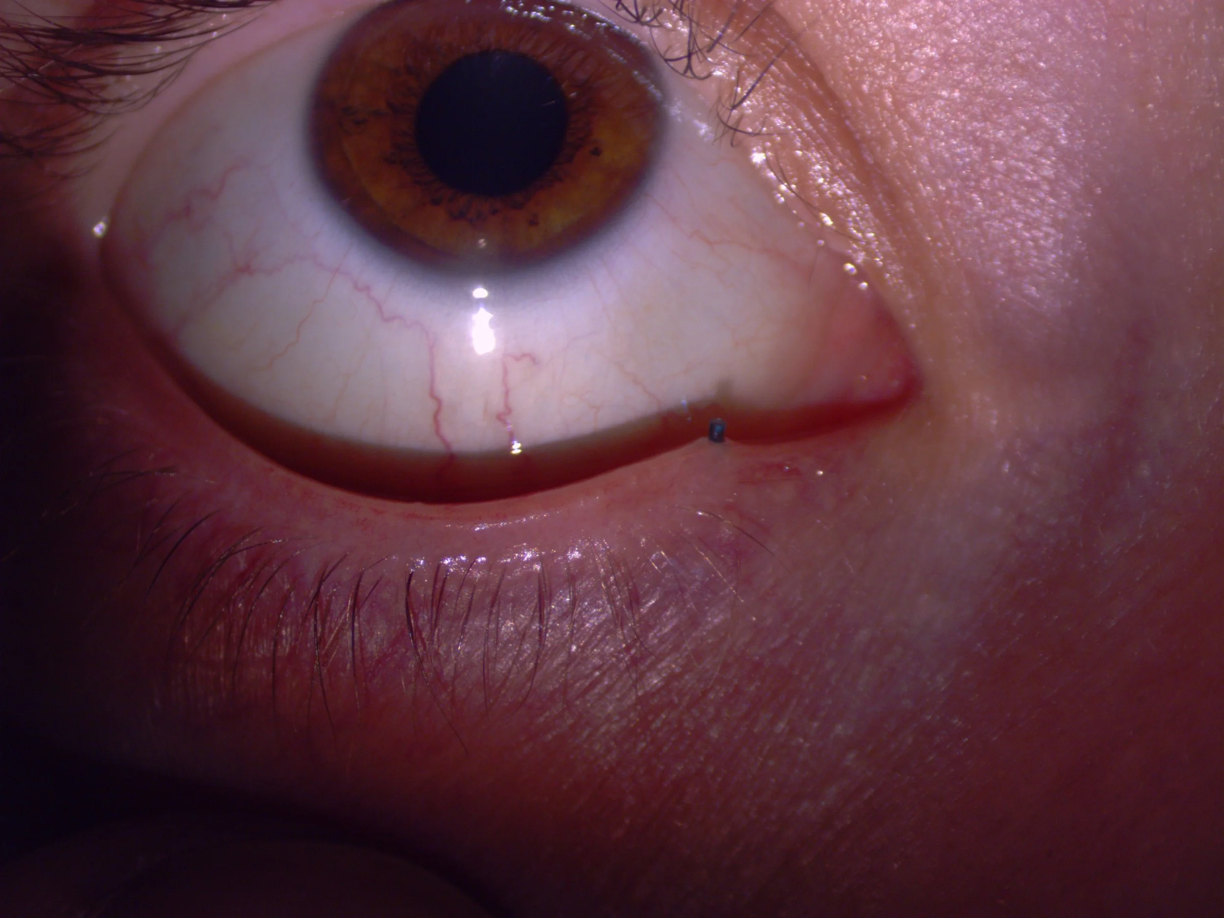  This picture shows a small dissolvable punctal plug which has been inserted into the tear duct. This picture was taken midway through it and it would usually be pushed further in so you wouldn’t feel or see it!  