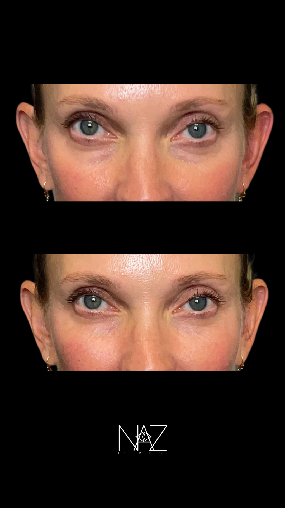 Under Eye + Midface Lift