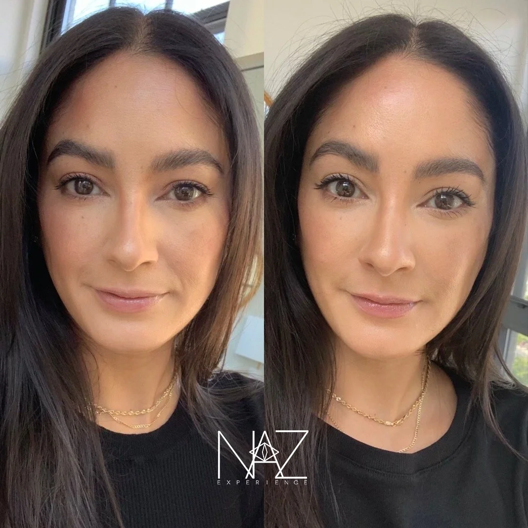 Under Eye, Lips, and Mid-Face Filler