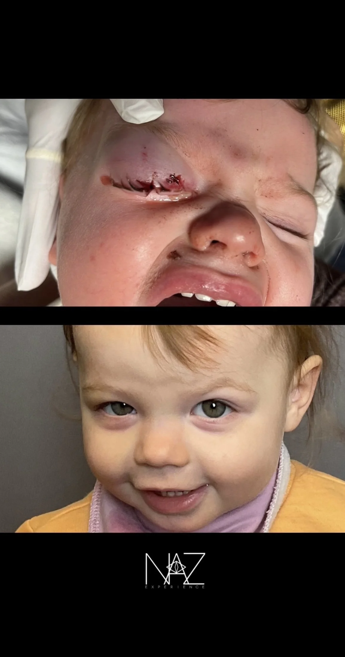 Eyelid Laceration Repair