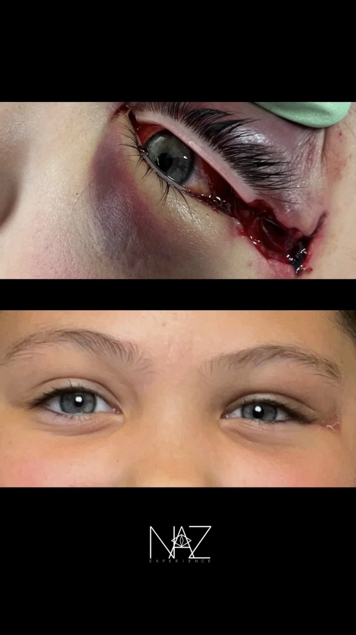 Repair of full thickness Eyelid and Canthus Laceration