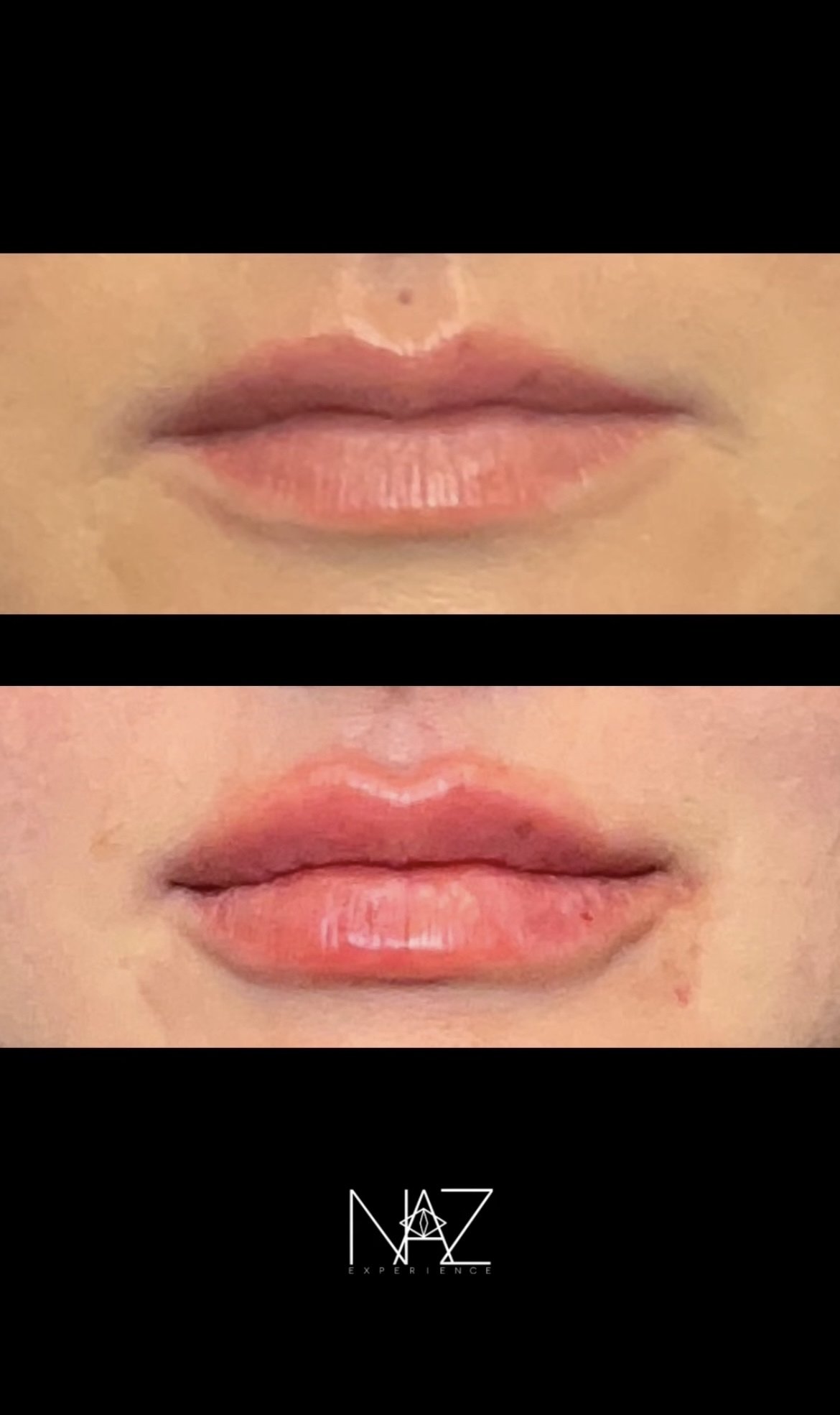 Lip Filler