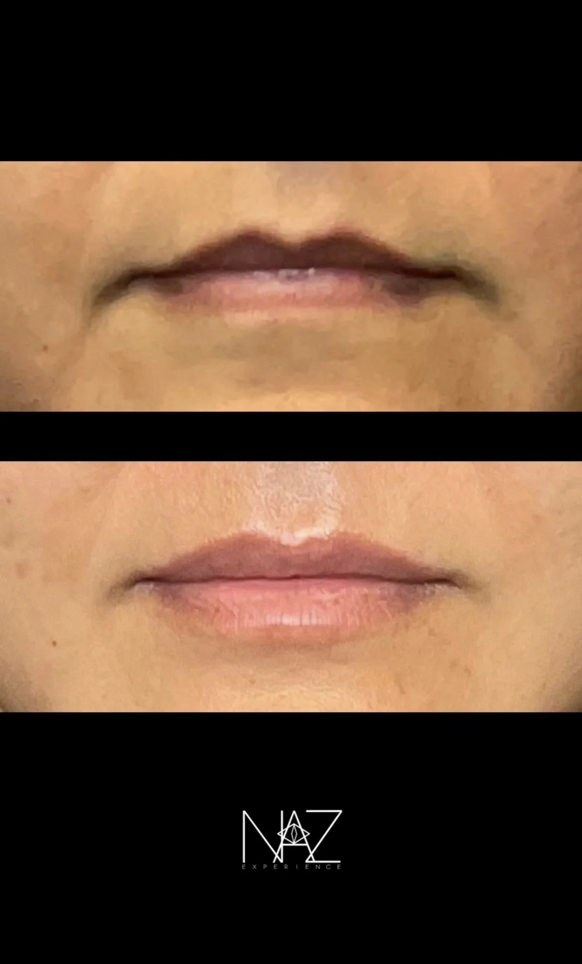 Lip Filler