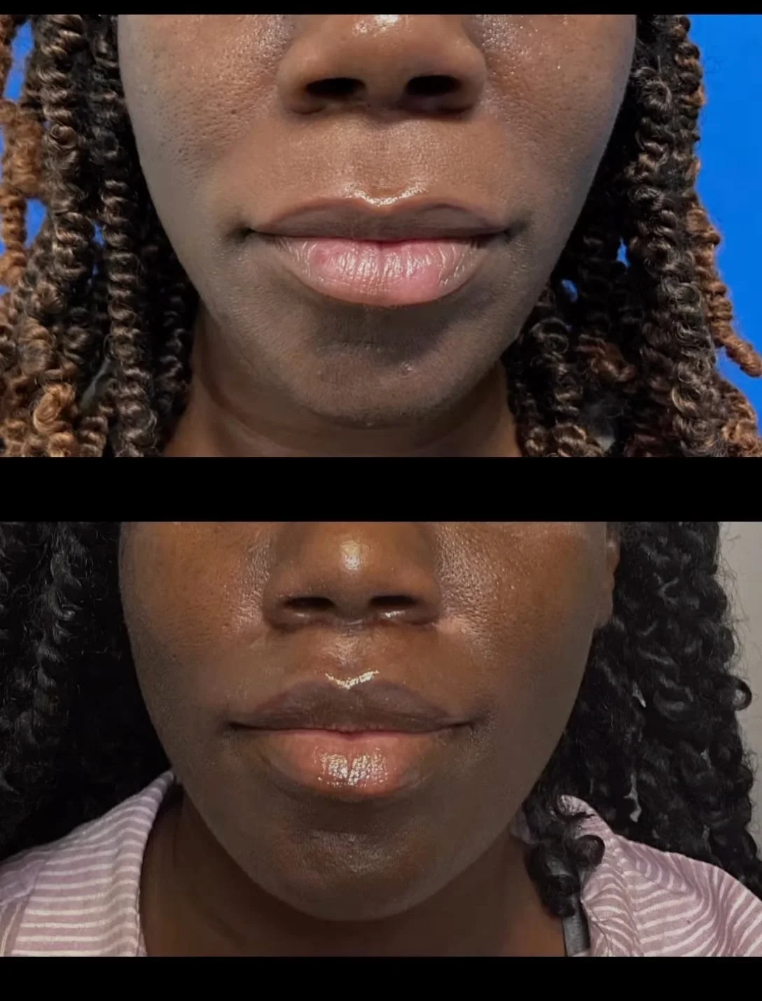 Lip Lift