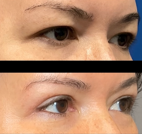 Bilateral Upper Eyelid Blepharoplasty
