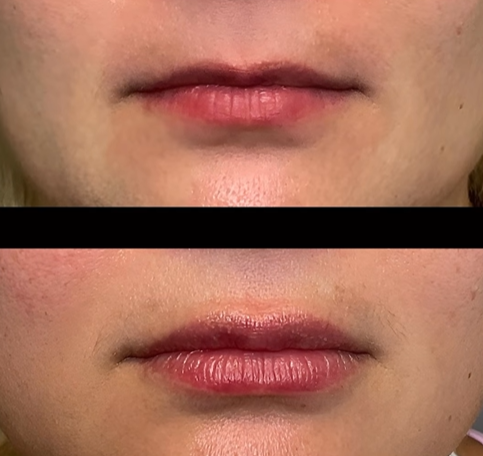 Lip Lift