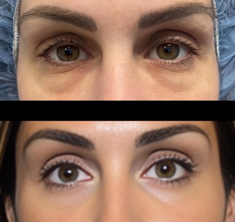 Lower Eyelid Blepharoplasty