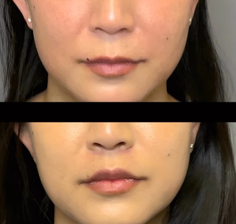 Lip Lift