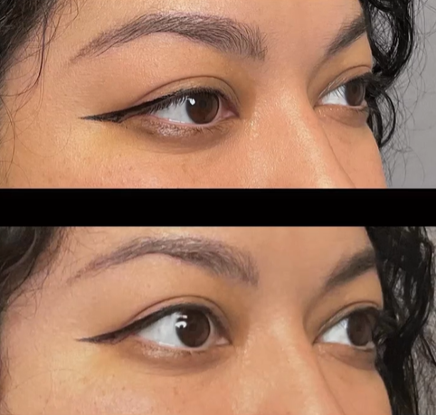 Upneeq Non-Invasive Upper Eye Lift