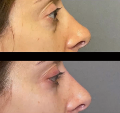 Liquid Rhinoplasty