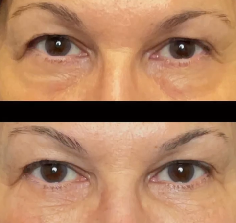 Non-invasive Under Eye Lift