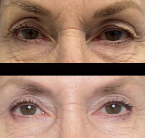 Upper Eyelid Blepharoplasty