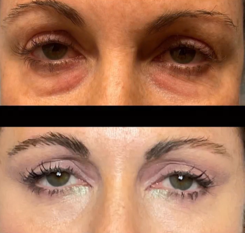 Lower Blepharoplasty with Fat Transposition + Butterfly Peel